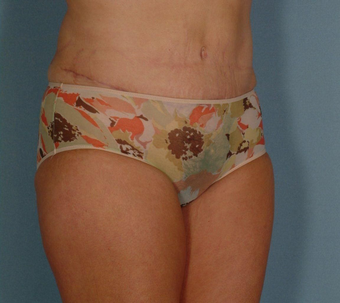Abdominoplasty Patient Photo - Case 11923 - after view-4