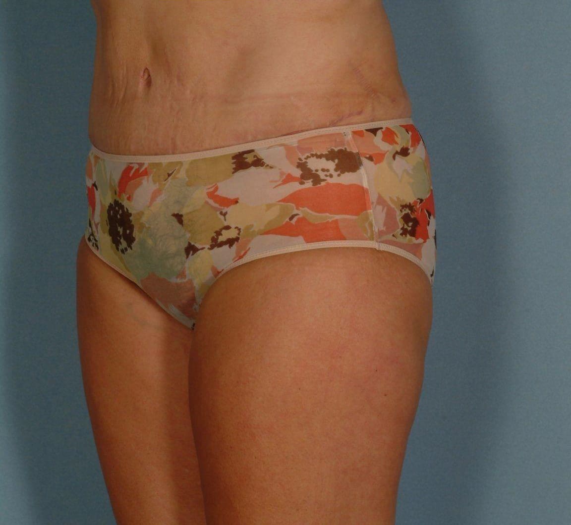 Abdominoplasty Patient Photo - Case 11923 - after view-3