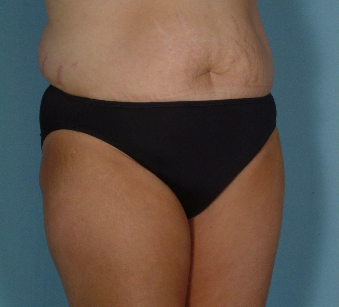 Abdominoplasty Patient Photo - Case 11923 - before view-4