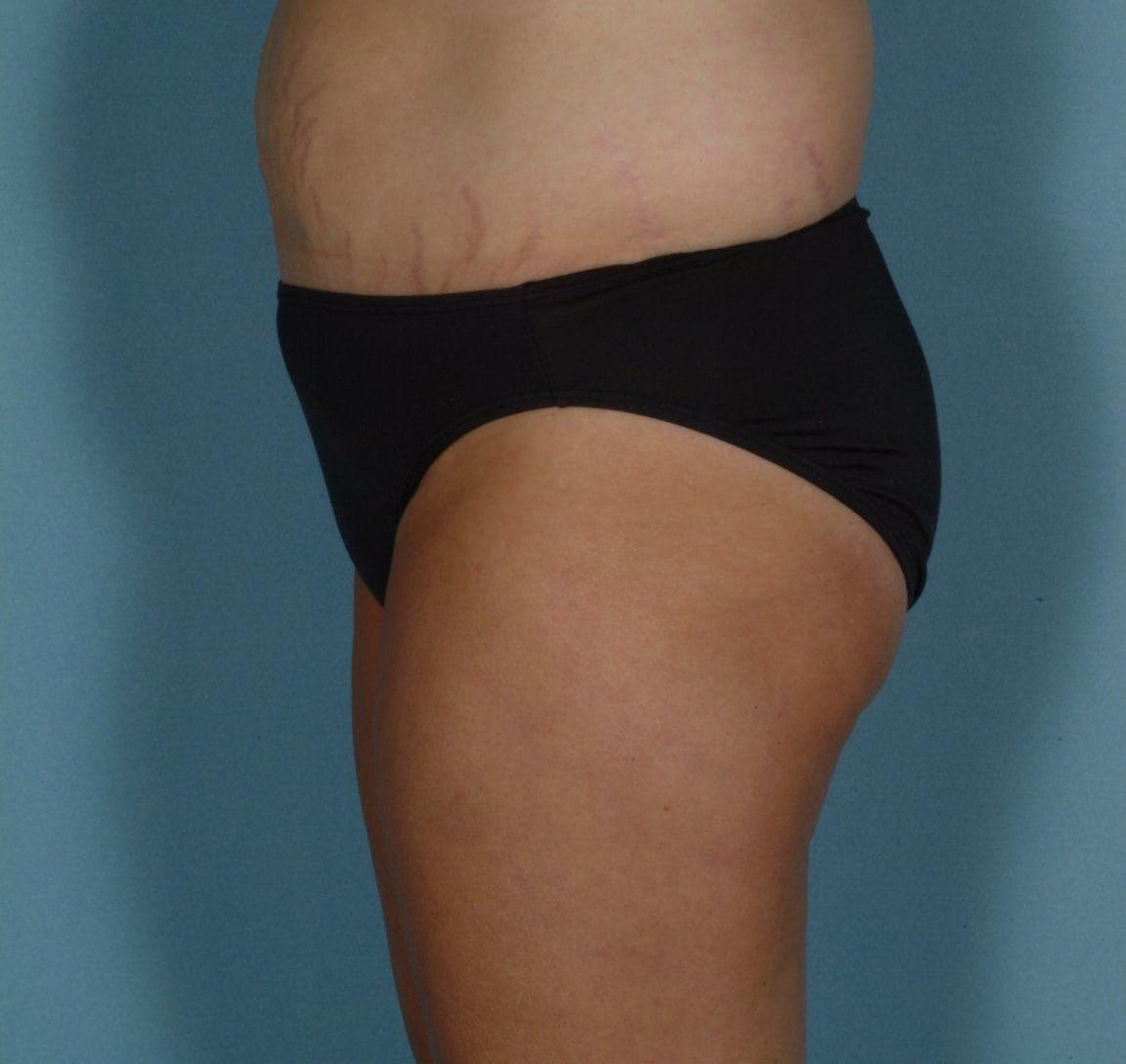 Abdominoplasty Patient Photo - Case 11923 - before view-1