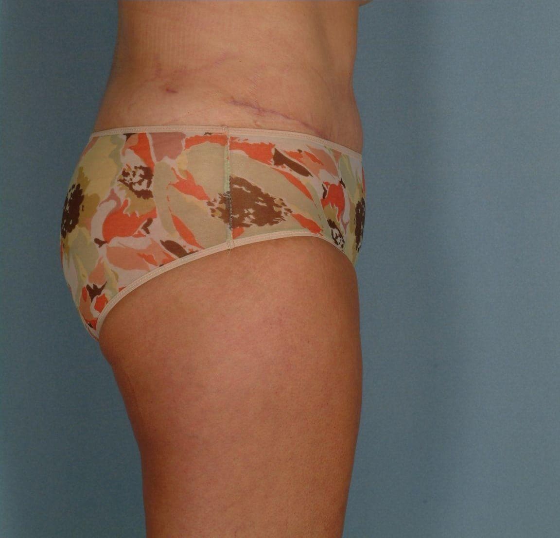 Abdominoplasty Patient Photo - Case 11923 - after view-2