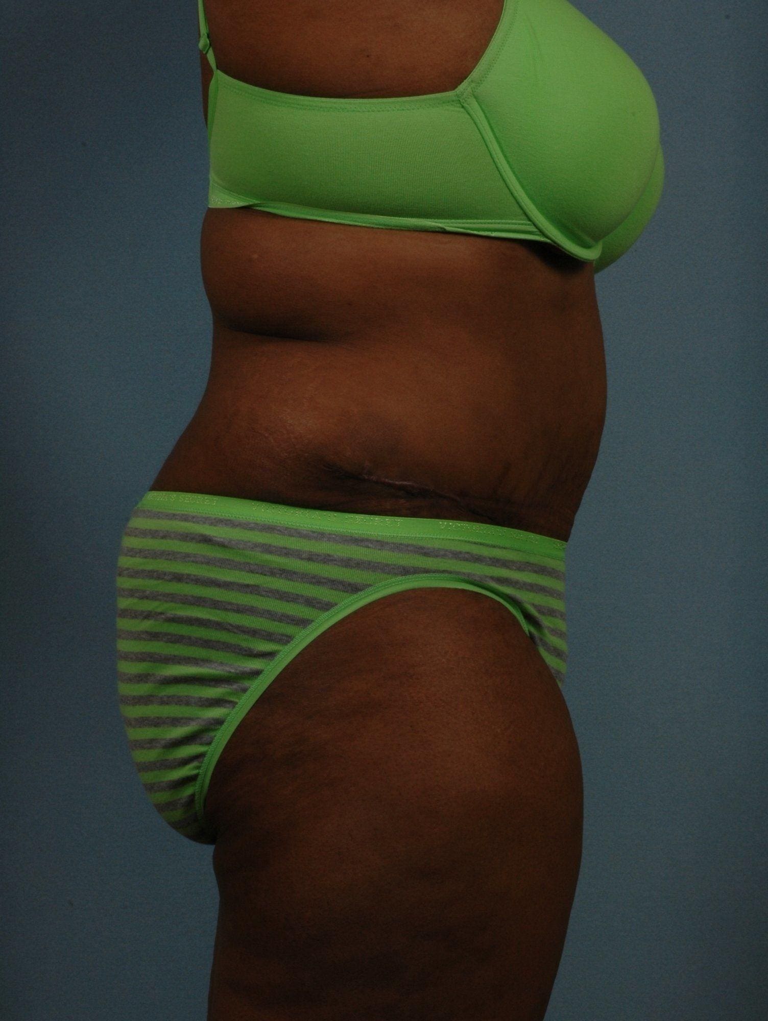 Abdominoplasty Patient Photo - Case 11947 - after view-2