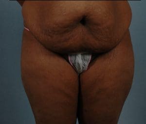 Abdominoplasty - Case 11947 - Before