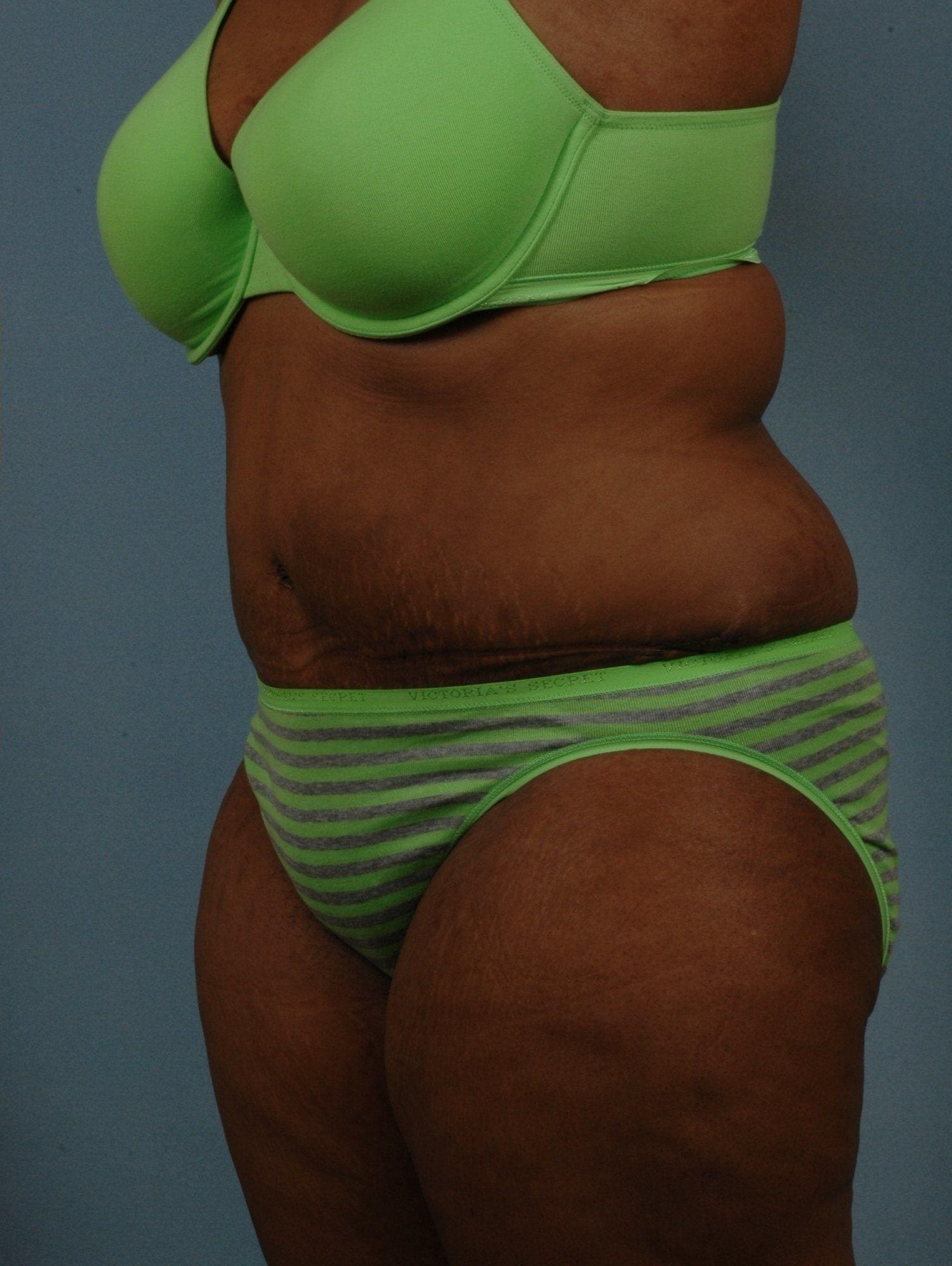 Abdominoplasty Patient Photo - Case 11947 - after view-3