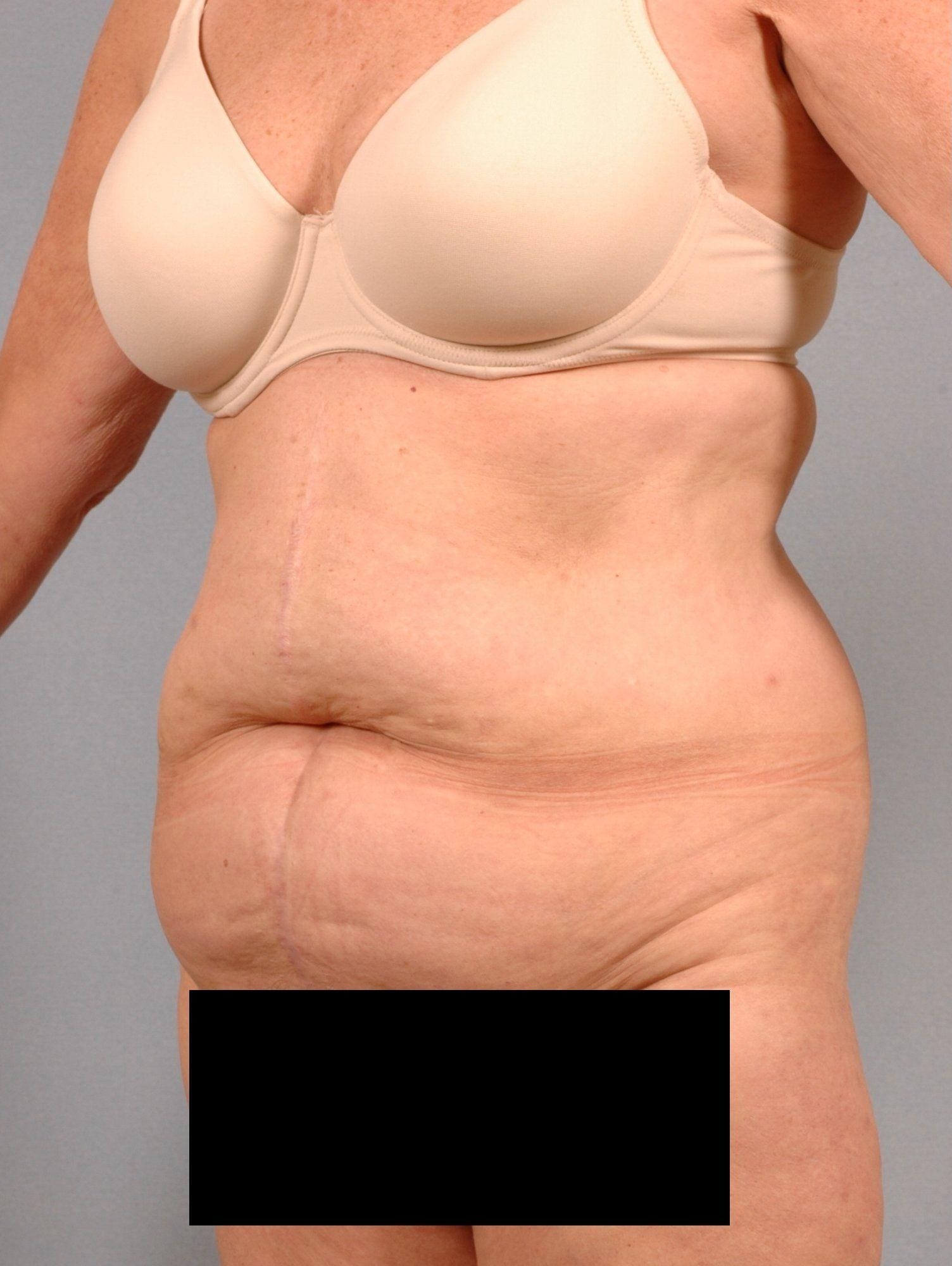 Abdominoplasty Patient Photo - Case 11959 - before view-3