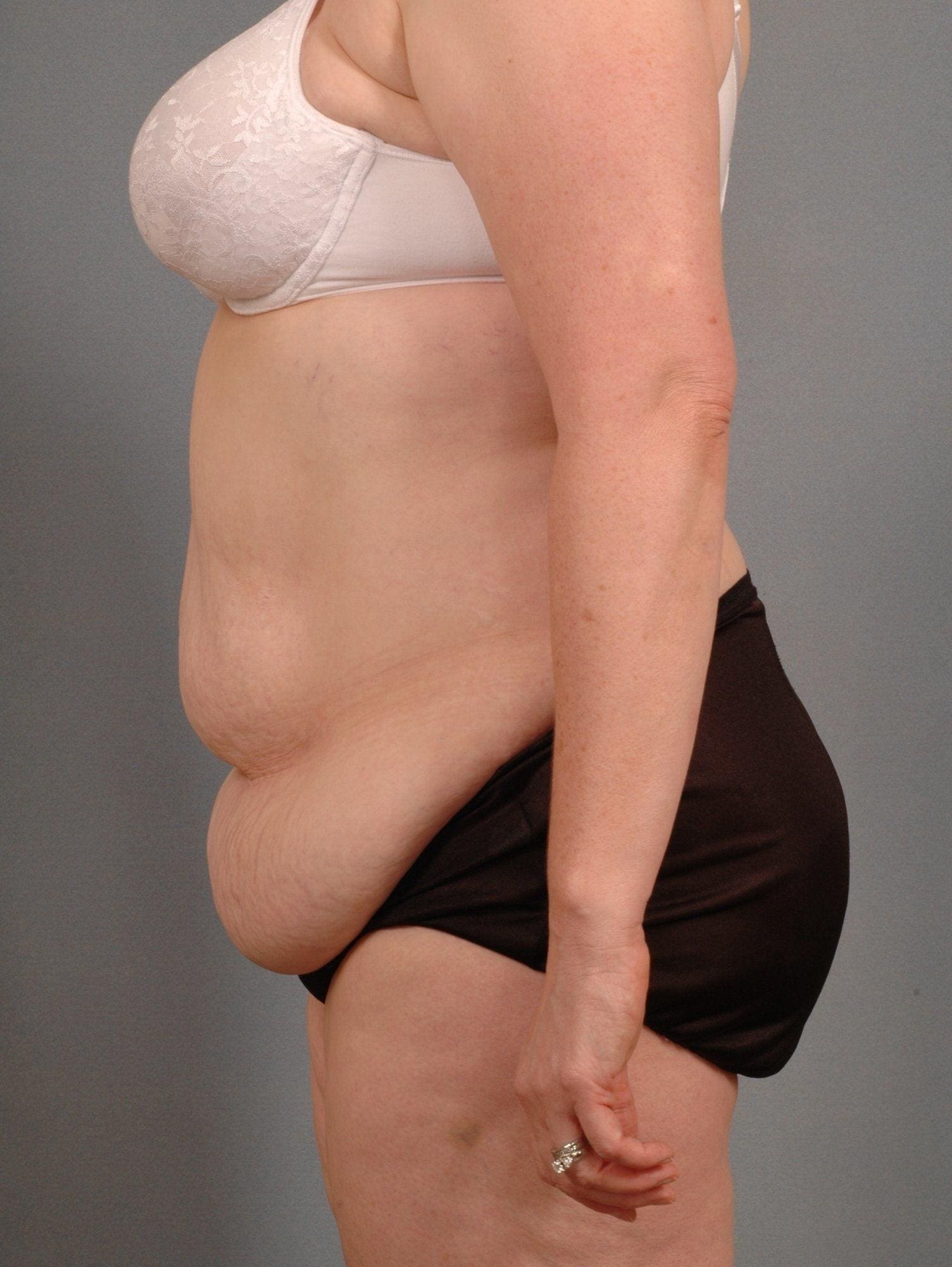 Abdominoplasty Patient Photo - Case 11971 - before view-1