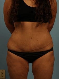 Abdominoplasty - Case 11992 - After