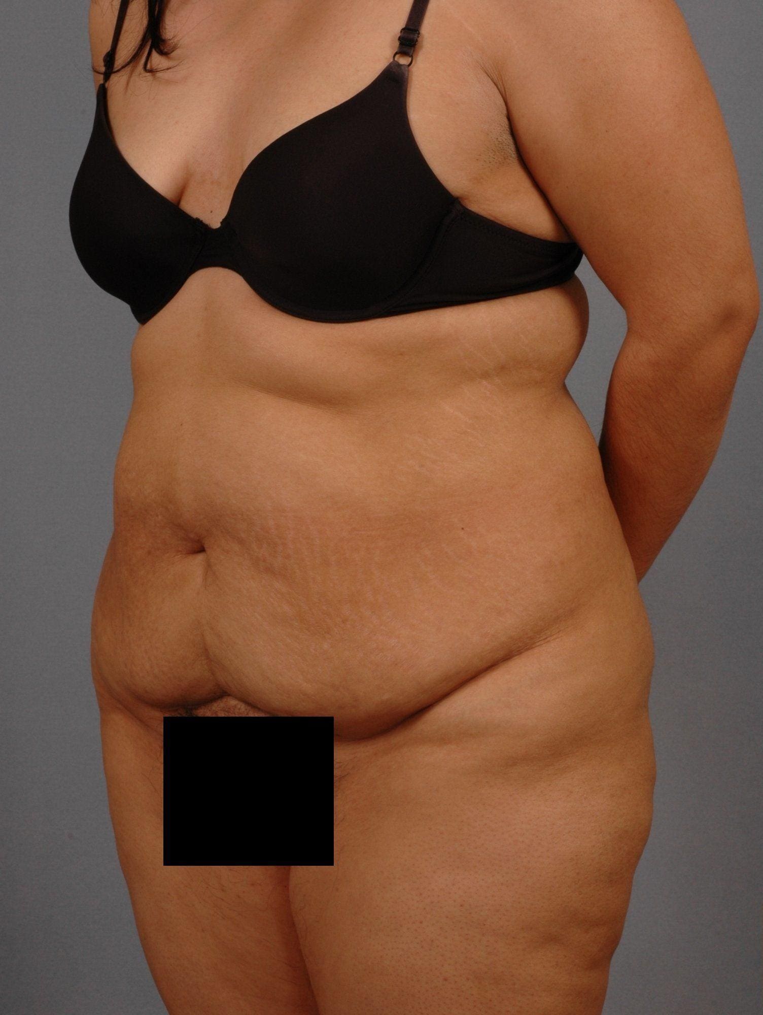 Abdominoplasty Patient Photo - Case 11992 - before view-3