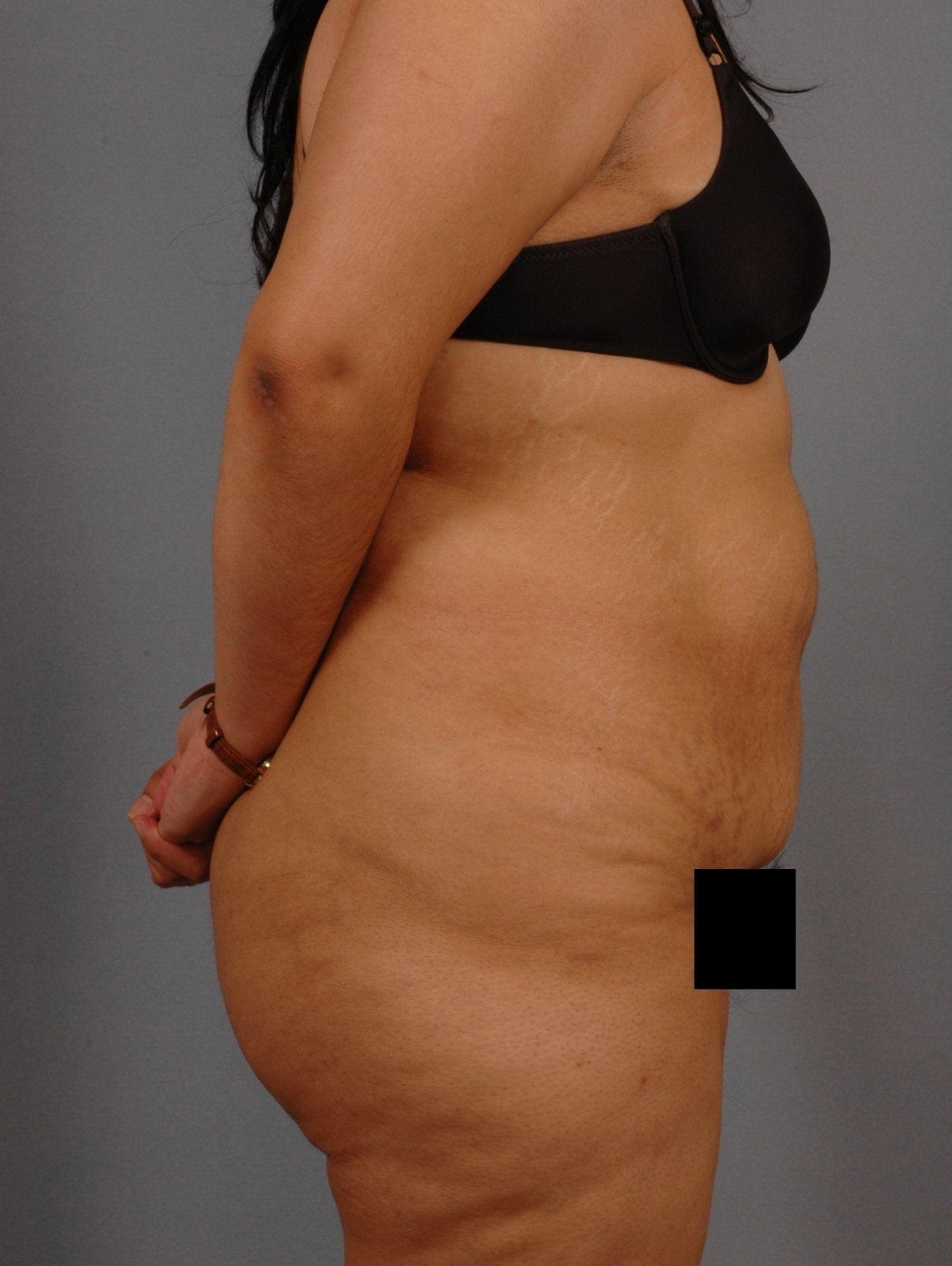 Abdominoplasty Patient Photo - Case 11992 - before view-2
