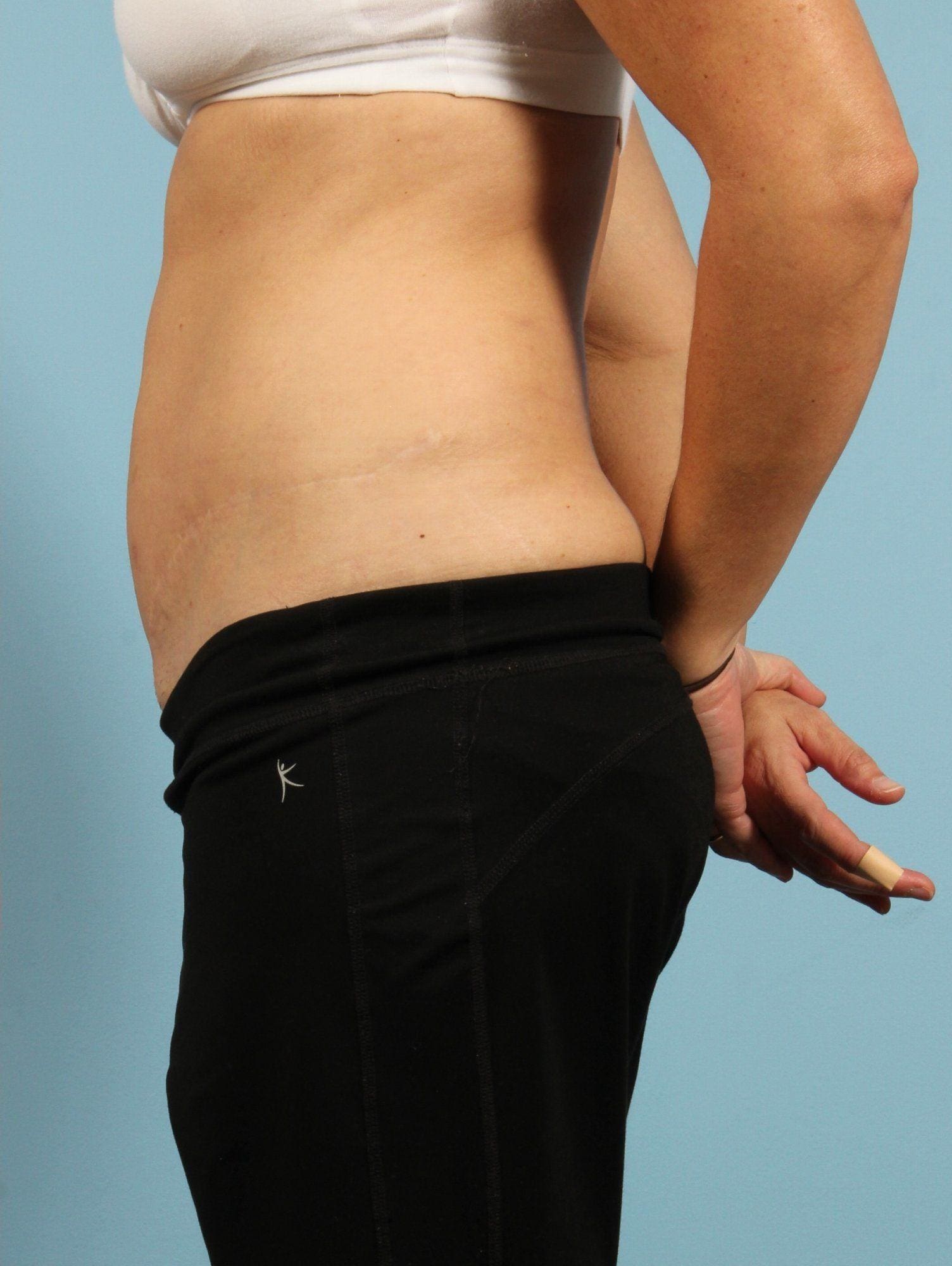 Abdominoplasty Patient Photo - Case 12004 - after view-1
