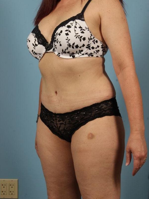 Abdominoplasty Patient Photo - Case 12024 - after view-3