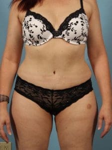 Abdominoplasty - Case 12024 - After