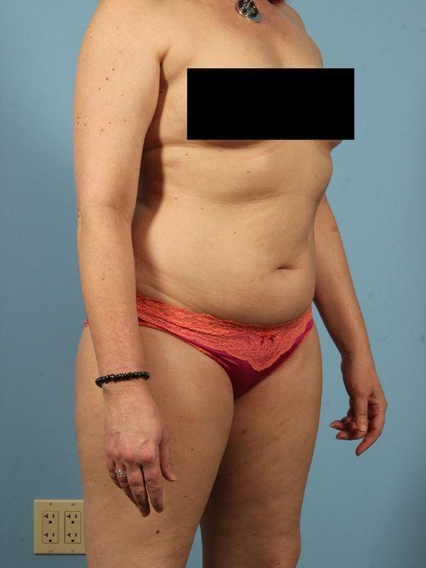 Abdominoplasty Patient Photo - Case 12024 - before view-4