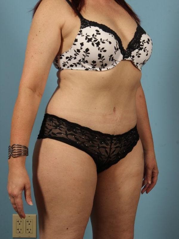 Abdominoplasty Patient Photo - Case 12024 - after view-4
