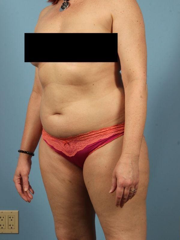 Abdominoplasty Patient Photo - Case 12024 - before view-3