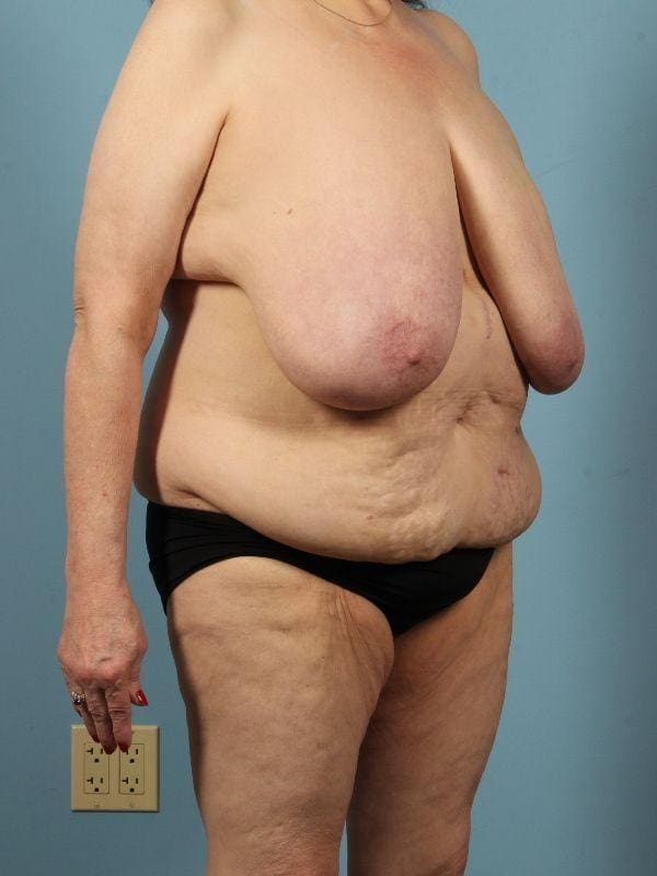 Abdominoplasty Patient Photo - Case 12046 - before view-4