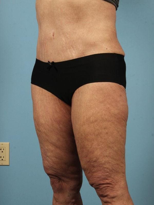 Abdominoplasty Patient Photo - Case 12058 - after view-3