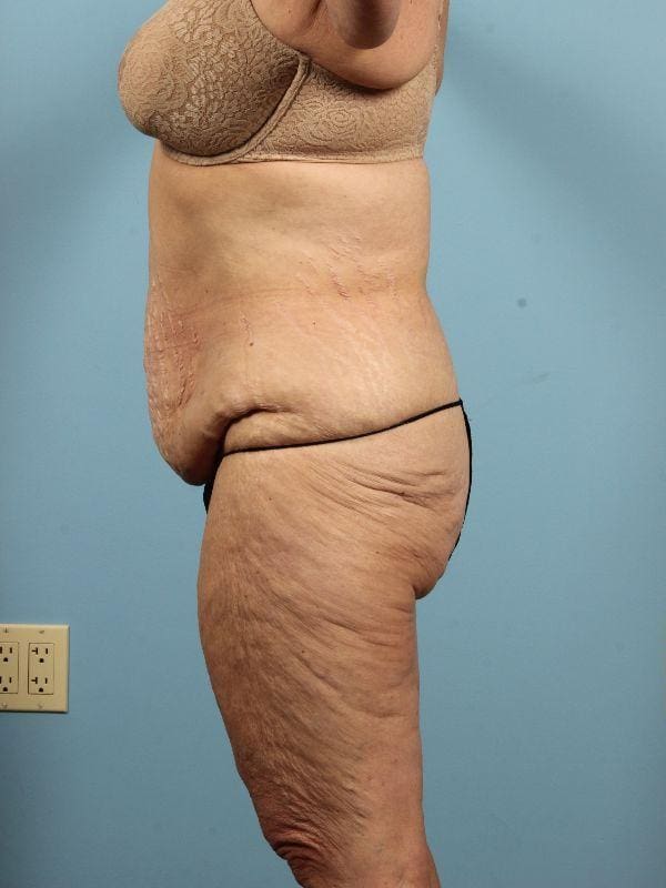 Abdominoplasty Patient Photo - Case 12058 - before view-1
