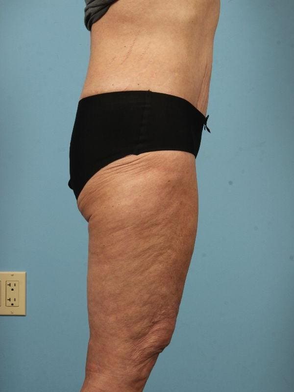 Abdominoplasty Patient Photo - Case 12058 - after view-2