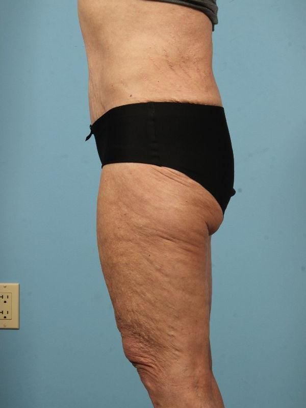 Abdominoplasty Patient Photo - Case 12058 - after view-1