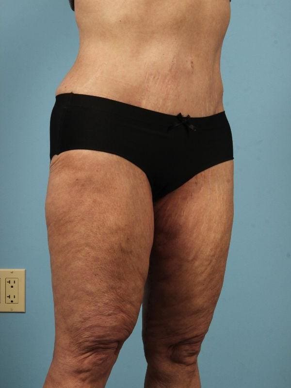 Abdominoplasty Patient Photo - Case 12058 - after view-4