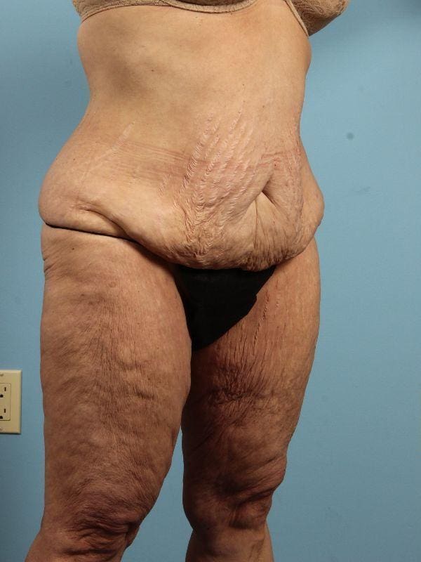 Abdominoplasty Patient Photo - Case 12058 - before view-4