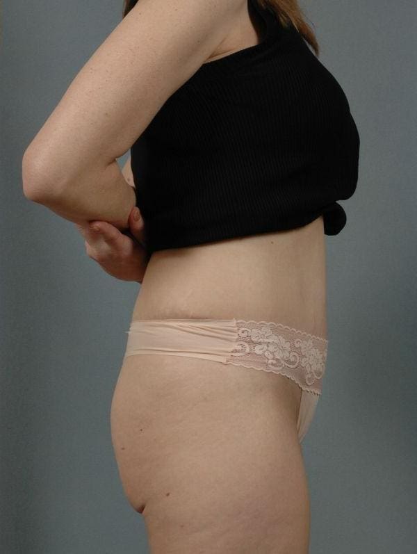 Abdominoplasty Patient Photo - Case 12070 - after view-2