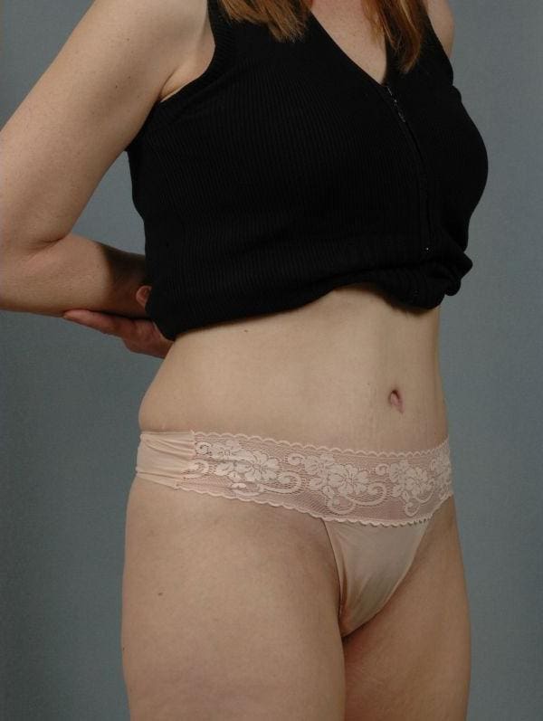Abdominoplasty Patient Photo - Case 12070 - after view-4
