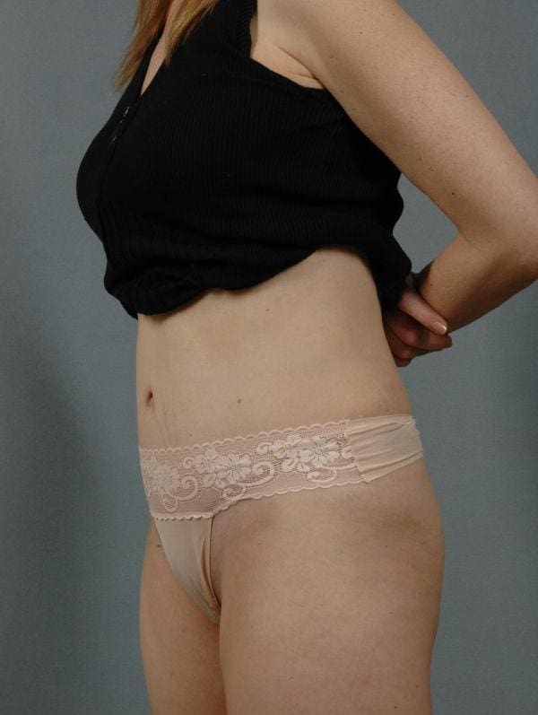Abdominoplasty Patient Photo - Case 12070 - after view-3