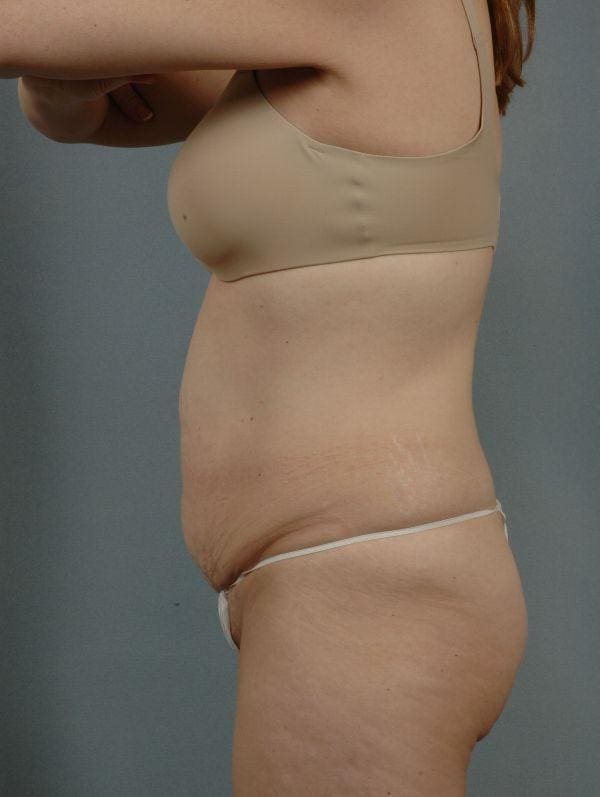 Abdominoplasty Patient Photo - Case 12070 - before view-1