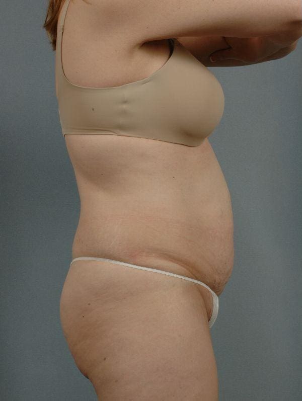 Abdominoplasty Patient Photo - Case 12070 - before view-2