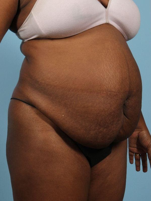 Abdominoplasty Patient Photo - Case 12082 - before view-2