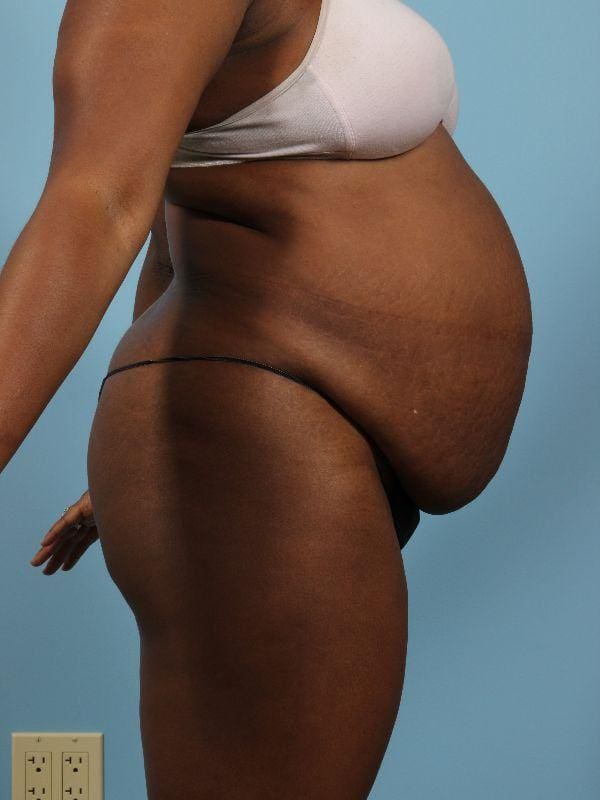 Abdominoplasty Patient Photo - Case 12082 - before view-1