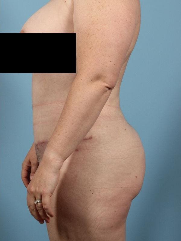 Abdominoplasty Patient Photo - Case 12090 - after view-1