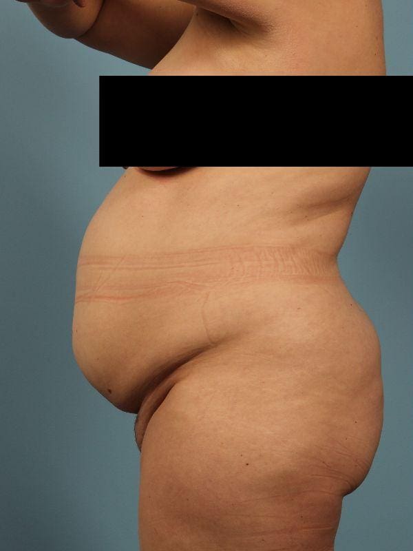 Abdominoplasty Patient Photo - Case 12090 - before view-1