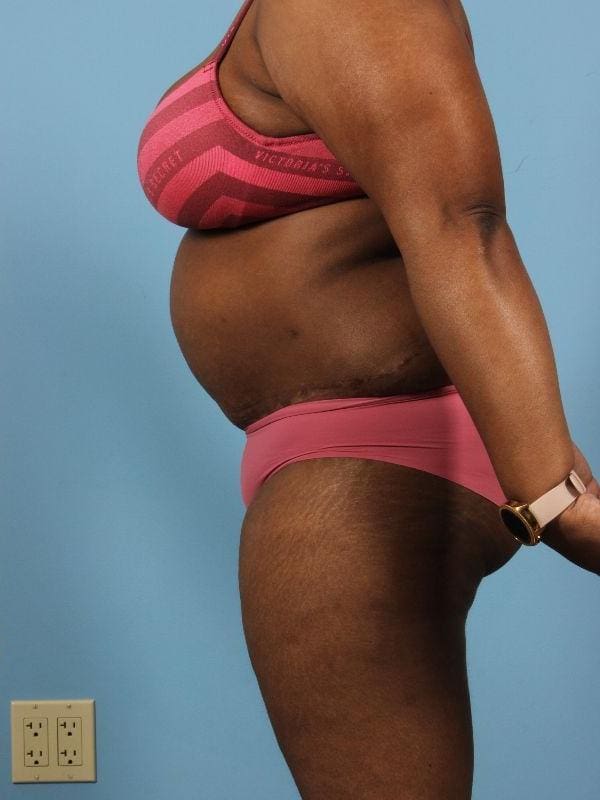 Abdominoplasty Patient Photo - Case 12098 - after view-1
