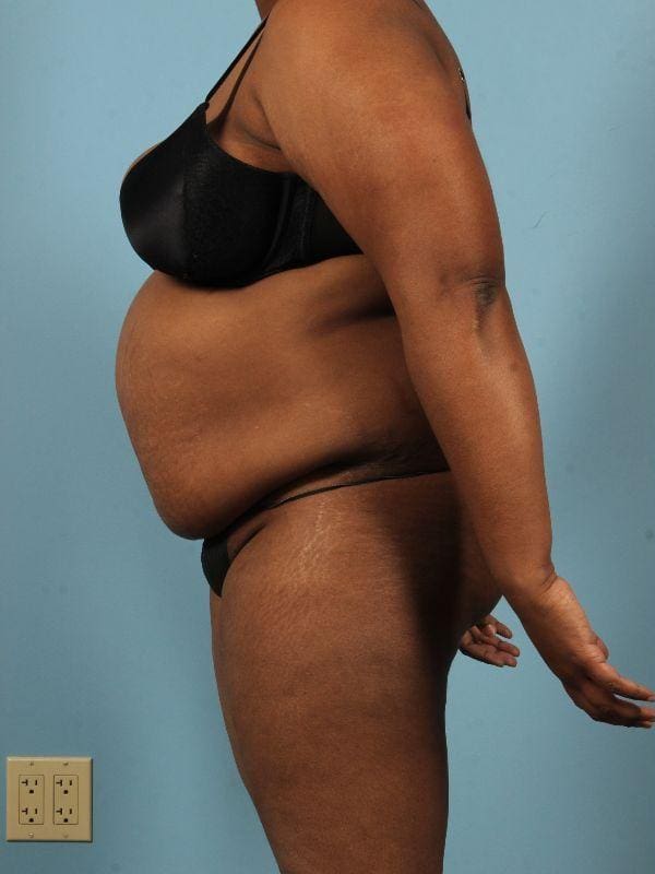 Abdominoplasty Patient Photo - Case 12098 - before view-1