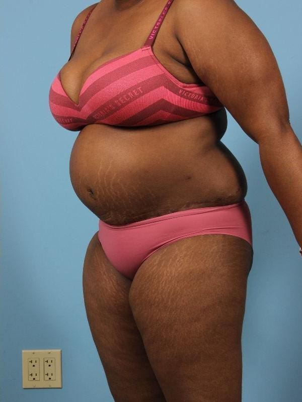 Abdominoplasty Patient Photo - Case 12098 - after view-3