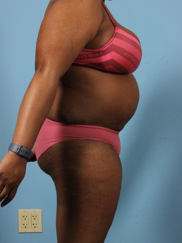Abdominoplasty Patient Photo - Case 12098 - after view-2
