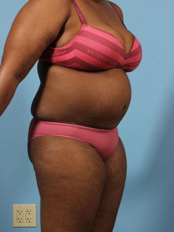 Abdominoplasty Patient Photo - Case 12098 - after view-4