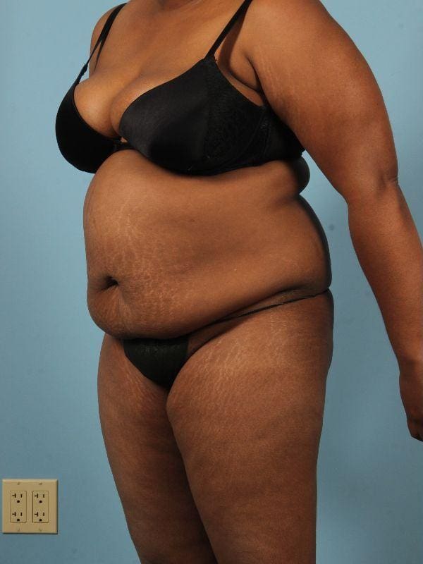 Abdominoplasty Patient Photo - Case 12098 - before view-3