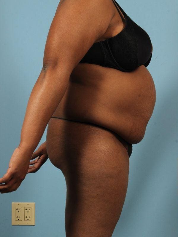 Abdominoplasty Patient Photo - Case 12098 - before view-2