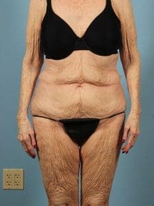 Abdominoplasty - Case 12110 - Before