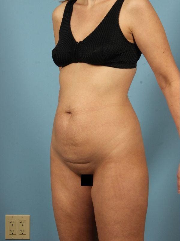 Abdominoplasty Patient Photo - Case 12122 - before view-3