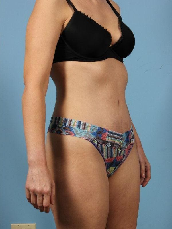 Abdominoplasty Patient Photo - Case 12122 - after view-4