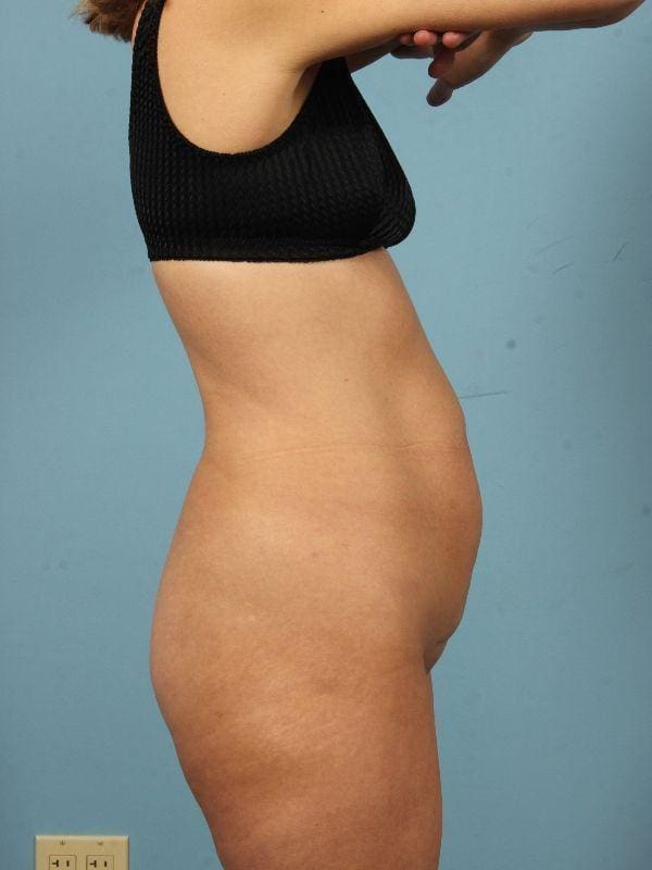 Abdominoplasty Patient Photo - Case 12122 - before view-2