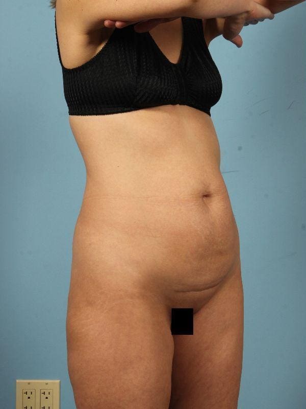 Abdominoplasty Patient Photo - Case 12122 - before view-4