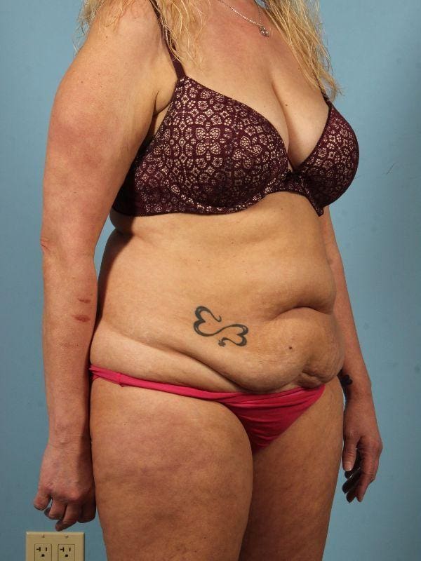 Abdominoplasty Patient Photo - Case 12146 - before view-4