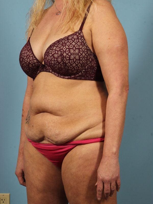 Abdominoplasty Patient Photo - Case 12146 - before view-3