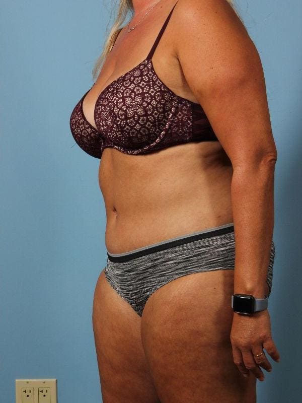 Abdominoplasty Patient Photo - Case 12146 - after view-3
